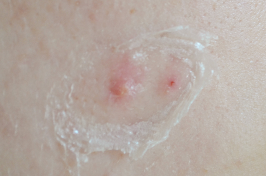 dermaxir spot treatment 2
